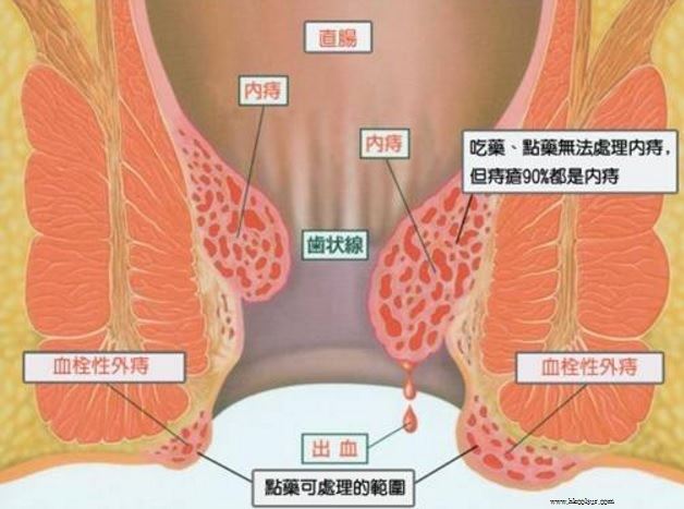 痔疮长什么样子的图片