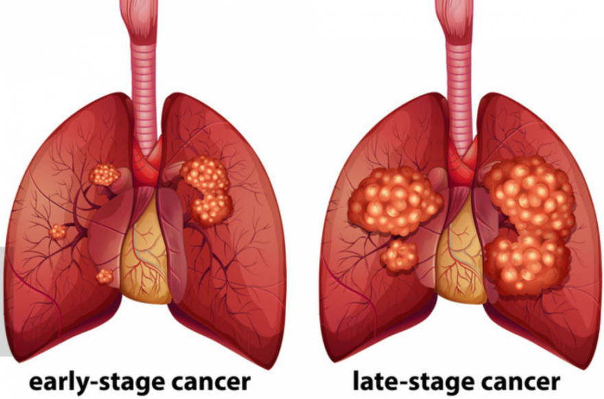 肺癌是我国死亡率最高的癌症