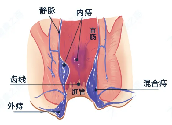 外痔疮图片初期图片